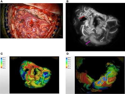 Application of Indocyanine Green During Arteriovenous Malformation Surgery: Evidence, Techniques, and Practical Pearls